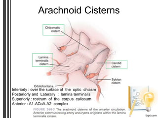 Arachnoid Cisterns
Inferiorly : over the surface of the optic chiasm
Posteriorly and Laterally : lamina terminalis
Superiorly : rostrum of the corpus callosum
Anterior : A1-ACoA-A2 complex
 