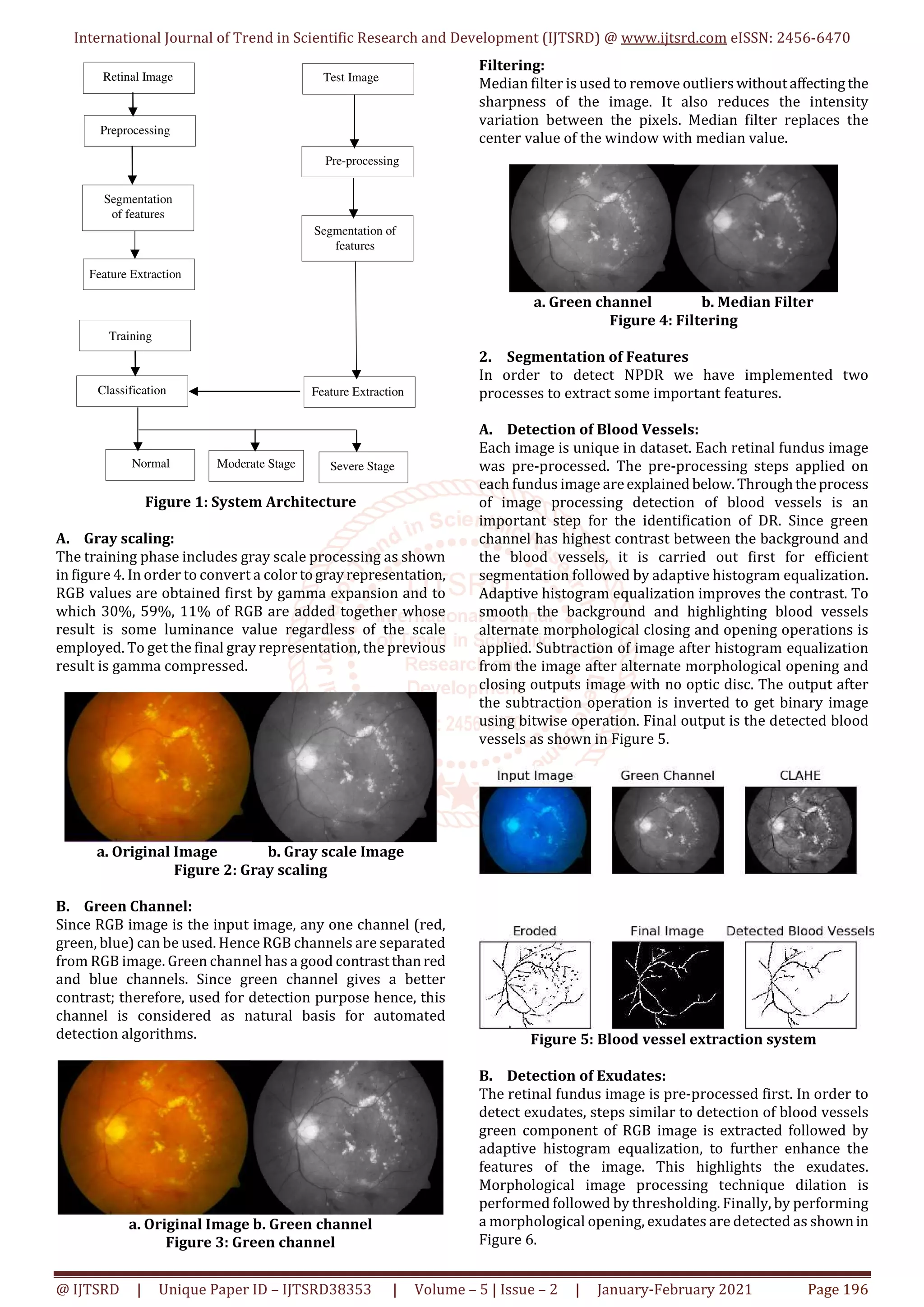 International Journal of Trend in Scientific Research and Development (IJTSRD) @ www.ijtsrd.com eISSN: 2456-6470
@ IJTSRD | Unique Paper ID – IJTSRD38353 | Volume – 5 | Issue – 2 | January-February 2021 Page 196
Figure 1: System Architecture
A. Gray scaling:
The training phase includes gray scale processing as shown
in figure 4. In order to convert a colortograyrepresentation,
RGB values are obtained first by gamma expansion and to
which 30%, 59%, 11% of RGB are added together whose
result is some luminance value regardless of the scale
employed. To get the final gray representation, the previous
result is gamma compressed.
a. Original Image b. Gray scale Image
Figure 2: Gray scaling
B. Green Channel:
Since RGB image is the input image, any one channel (red,
green, blue) can be used. Hence RGB channels are separated
from RGB image. Green channel has a good contrastthanred
and blue channels. Since green channel gives a better
contrast; therefore, used for detection purpose hence, this
channel is considered as natural basis for automated
detection algorithms.
a. Original Image b. Green channel
Figure 3: Green channel
Filtering:
Median filter is used to remove outliers withoutaffecting the
sharpness of the image. It also reduces the intensity
variation between the pixels. Median filter replaces the
center value of the window with median value.
a. Green channel b. Median Filter
Figure 4: Filtering
2. Segmentation of Features
In order to detect NPDR we have implemented two
processes to extract some important features.
A. Detection of Blood Vessels:
Each image is unique in dataset. Each retinal fundus image
was pre-processed. The pre-processing steps applied on
each fundus image areexplained below.Throughtheprocess
of image processing detection of blood vessels is an
important step for the identification of DR. Since green
channel has highest contrast between the background and
the blood vessels, it is carried out first for efficient
segmentation followed by adaptive histogram equalization.
Adaptive histogram equalization improves the contrast. To
smooth the background and highlighting blood vessels
alternate morphological closing and opening operations is
applied. Subtraction of image after histogram equalization
from the image after alternate morphological opening and
closing outputs image with no optic disc. The output after
the subtraction operation is inverted to get binary image
using bitwise operation. Final output is the detected blood
vessels as shown in Figure 5.
Figure 5: Blood vessel extraction system
B. Detection of Exudates:
The retinal fundus image is pre-processed first. In order to
detect exudates, steps similar to detection of blood vessels
green component of RGB image is extracted followed by
adaptive histogram equalization, to further enhance the
features of the image. This highlights the exudates.
Morphological image processing technique dilation is
performed followed by thresholding. Finally, by performing
a morphological opening, exudates are detected as shownin
Figure 6.
Pre-processing
Test Image
Feature Extraction
Segmentation of
features
Training
Classification
Normal Moderate Stage
Feature Extraction
Retinal Image
Preprocessing
Segmentation
of features
Severe Stage
 