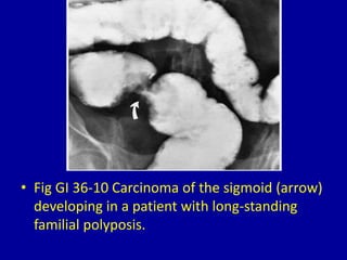 36 filling defects in the colon | PPTX