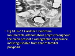 36 filling defects in the colon | PPTX