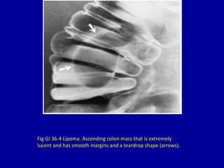 36 filling defects in the colon | PPTX