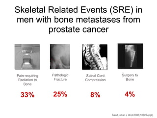 Skeletal Related Events (SRE) in men with bone metastases from prostate cancer Pathologic Fracture 25% Pain requiring Radiation to Bone 33% Surgery to Bone 4% Spinal Cord Compression 8% Saad, et al. J Urol 2003;169(Suppl). 