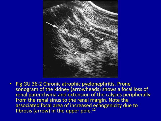 36 Focal Or Diffuse Distortion Of Normal Renal