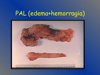 PAL (edema+hemorragia) 