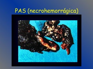 PAS (necrohemorrágica) 