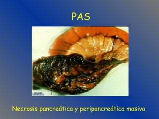 PAS Necrosis pancreática y peripancreática masiva 