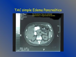 TAC simple Edema Pancreático 