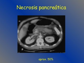 Necrosis pancreática aprox. 50% 