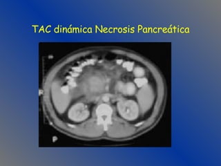 TAC dinámica Necrosis Pancreática 