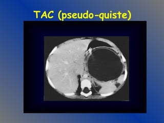 TAC (pseudo-quiste) 
