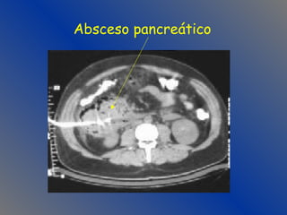 Absceso pancreático 