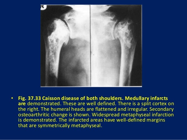 caisson disease