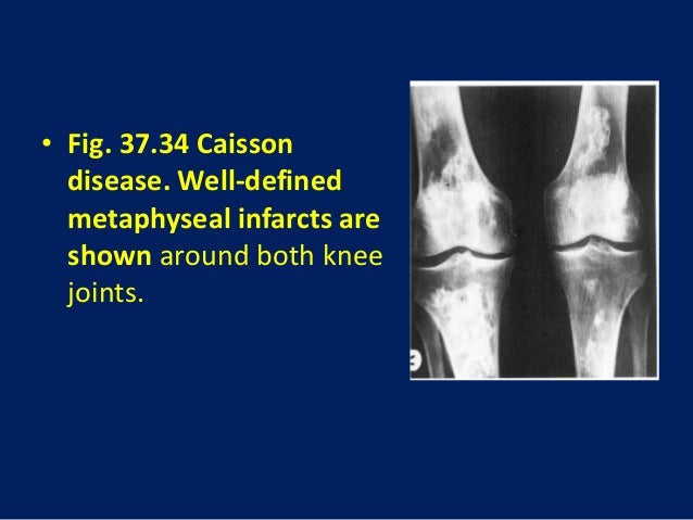 37 david sutton pictures avascualr necrosis caisson disease