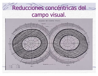 Reducciones concéntricas del
campo visual.