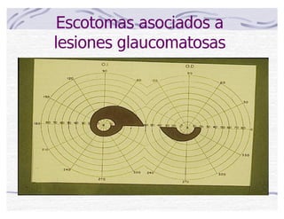 Escotomas asociados a
lesiones glaucomatosas