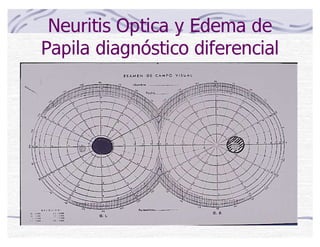 Neuritis Optica y Edema de
Papila diagnóstico diferencial