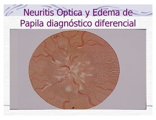 Neuritis Optica y Edema de
Papila diagnóstico diferencial