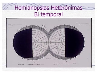 Hemianopsias Heterónimas
Bi temporal