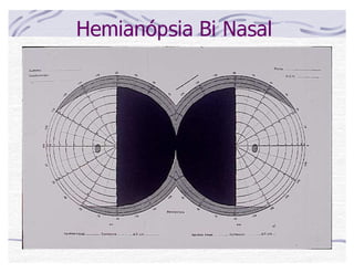Hemianópsia Bi Nasal