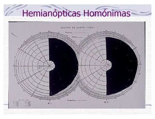 Hemianópticas Homónimas