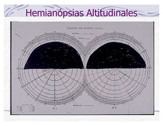 Hemianópsias Altitudinales