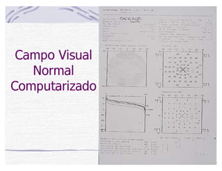 Campo Visual
Normal
Computarizado