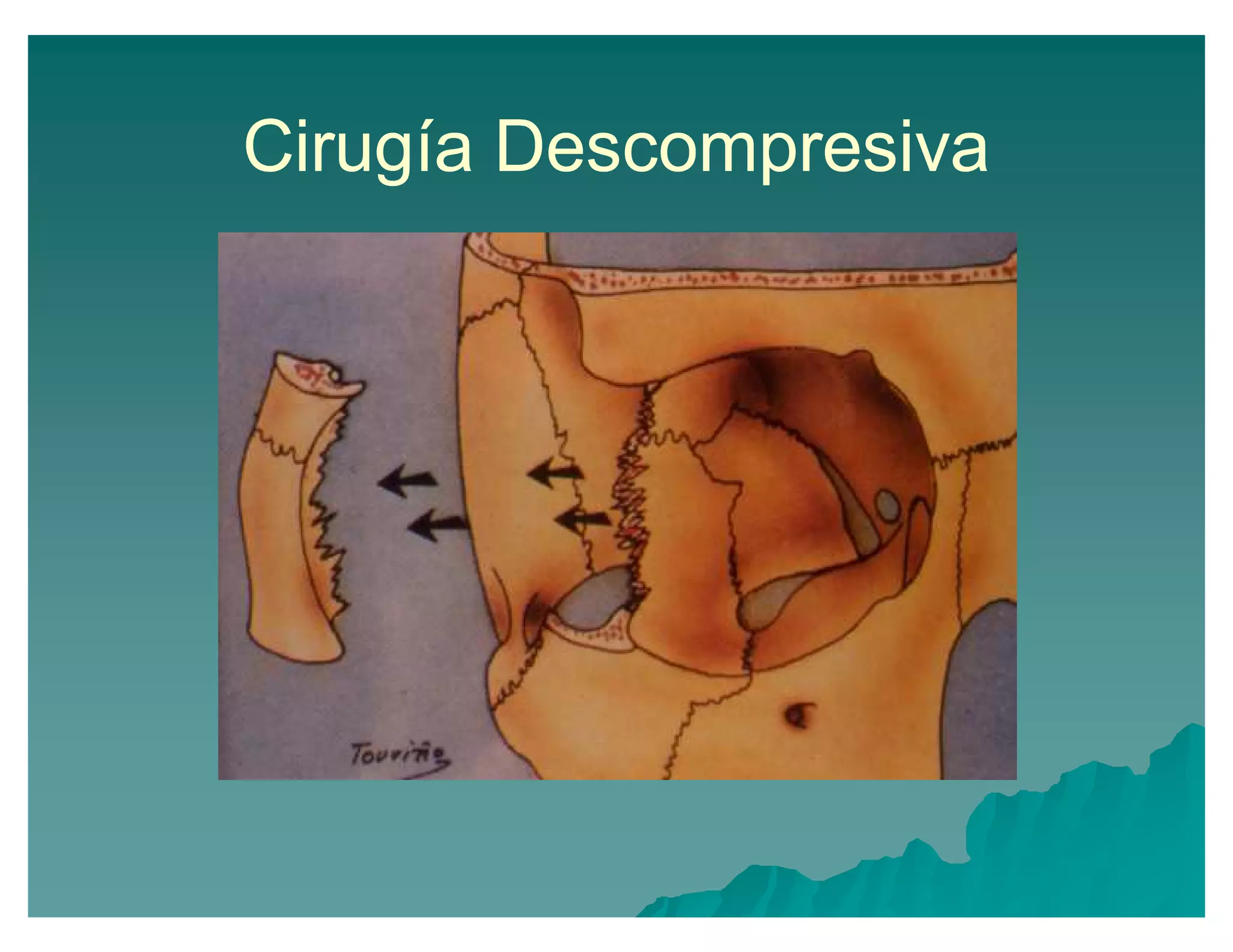 Cirugía Descompresiva