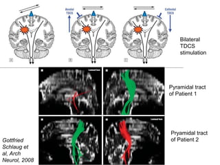 Pryamidal tract
of Patient 2
Pyramidal tract
of Patient 1
Bilateral
TDCS
stimulation
Gottfried
Schlaug et
al, Arch
Neurol, 2008
 