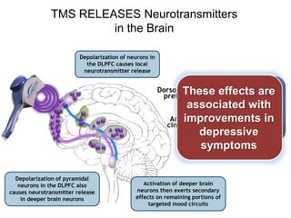 TMS RELEASES Neurotransmitters
in the Brain
Depolarization of neurons in
the DLPFC causes local
neurotransmitter release
Depolarization of pyramidal
neurons in the DLPFC also
causes neurotransmitter release
in deeper brain neurons
Activation of deeper brain
neurons then exerts secondary
effects on remaining portions of
targeted mood circuits
Dorsolateral
prefrontal
cortex
Anterior
cingulate
cortex
Kito (2008) J Neuropsychiatry Clin Neurosci
These effects are
associated with
improvements in
depressive
symptoms
 