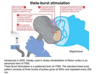 Introduced in 2005, initially used in stroke rehabilitation of Motor cortex is an
advanced form of TMS.
Theta Burst Stimulation is a patterned form of rTMS. The standard theta burst
pattern consists of three bursts of pulses given at 50Hz and repeated every 200
ms.
MagVenture
 