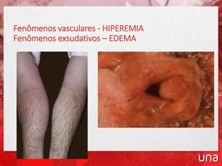 Fenômenos vasculares - HIPEREMIA
Fenômenos exsudativos – EDEMA
 