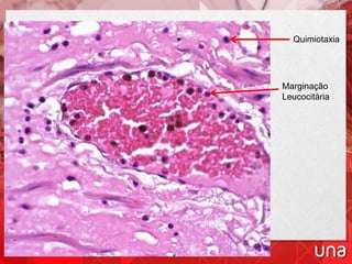60X
Marginação
Leucocitária
Quimiotaxia
 