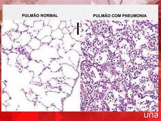 PULMÃO NORMAL PULMÃO COM PNEUMONIA
 