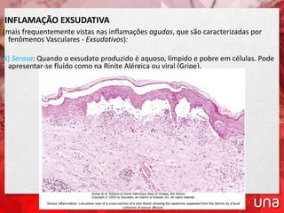 INFLAMAÇÃO EXSUDATIVA
(mais frequentemente vistas nas inflamações agudas, que são caracterizadas por
fenômenos Vasculares - Exsudativos):
A) Serosa: Quando o exsudato produzido é aquoso, límpido e pobre em células. Pode
apresentar-se fluído como na Rinite Alérgica ou viral (Gripe).
 