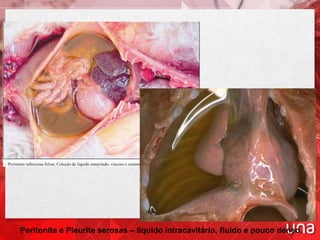 Peritonite e Pleurite serosas – líquido intracavitário, fluido e pouco denso.
 