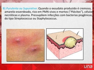 B) Purulenta ou Supurativa :Quando o exsudato produzido é cremoso,
amarelo-esverdeado, rico em PMN vivos e mortos ("Piócitos"), células
necróticas e plasma. Pressupõem infecções com bacterias piogênicas,
do tipo Streptococcus ou Staphylococcus.
 
