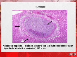 Abscesso
Abscesso hepático – piócitos e destruição tecidual circunscritos por
cápsula de tecido fibroso (setas). HE - 10x.
 