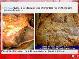 C)Fibrinosa: Quando o exsudato produzido é filamentoso, rico em fibrina, com
celularidade variável.
Pericardite fibrinosa – líquido intracavitário, denso e branco.
 