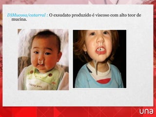 D)Mucosa/catarral : O exsudato produzido é viscoso com alto teor de
mucina.
 