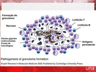 Formação do
granuloma
Necrose
Linfócito T
Linfócito B
Antígeno
persistente
Células gigantes
multinucleadas
(Fusão de
macrófagos)
 