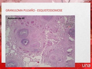Aumento de 4X
GRANULOMA PULMÃO - ESQUISTOSSOMOSE
 