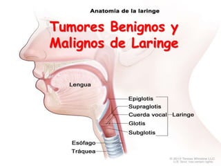 Tumores Benignos y
Malignos de Laringe
 