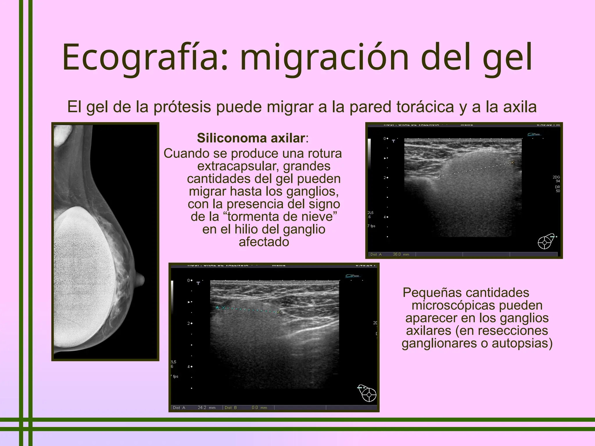 Complicaciones de prótesis mamarias conceptos | PPTX | Medical Health