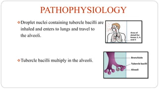 PATHOPHYSIOLOGY
Droplet nuclei containing tubercle bacilli are
inhaled and enters to lungs and travel to
the alveoli.
Tubercle bacilli multiply in the alveoli.
 