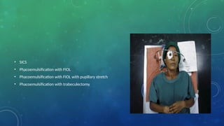 • SICS
• Phacoemulsification with FIOL
• Phacoemulsification with FIOL with pupillary stretch
• Phacoemulsification with trabeculectomy
 