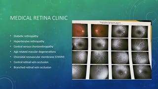 MEDICAL RETINA CLINIC
• Diabetic retinopathy
• Hypertensive retinopathy
• Central serous chorioretinopathy
• Age related macular degenerations
• Choroidal neovascular membrane (CNVM)
• Central retinal vein occlusion
• Branched retinal vein occlusion
 