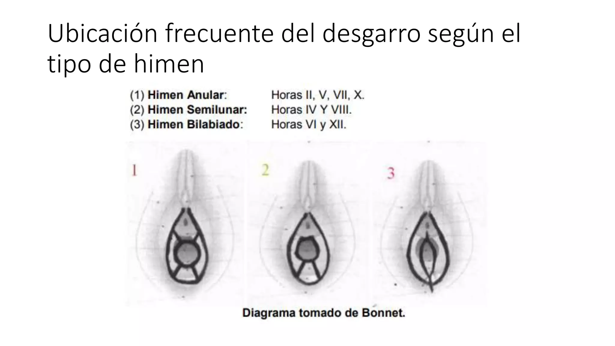tipos-de-desgarros-himeneal-pptx