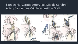 Extracranial Carotid Artery–to–Middle Cerebral
Artery Saphenous Vein Interposition Graft
 