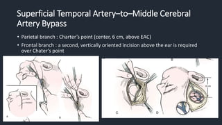 Superficial Temporal Artery–to–Middle Cerebral
Artery Bypass
• Parietal branch : Charter’s point (center, 6 cm, above EAC)
• Frontal branch : a second, vertically oriented incision above the ear is required
over Chater’s point
 