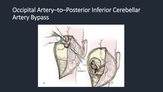 Occipital Artery–to–Posterior Inferior Cerebellar
Artery Bypass
 